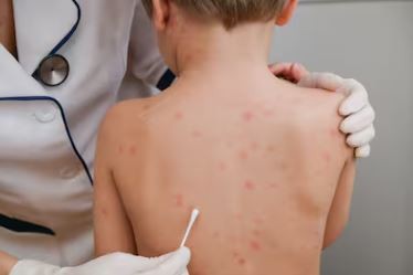 “¡Vacuná a tu hijo, ya!”: el desesperado ruego del Ministro de Salud por el brote de sarampión en Argentina