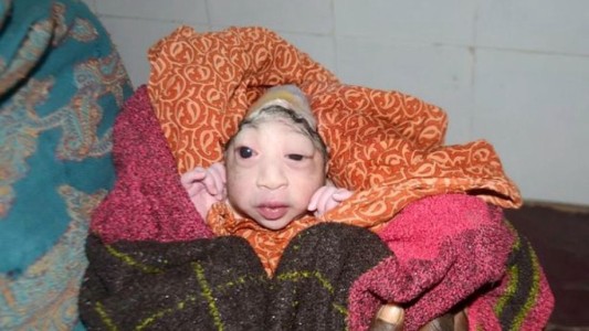 India: una mujer se niega a darle el pecho a su bebé por una malformación