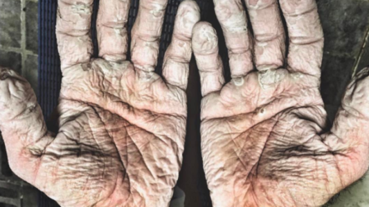 Así quedaron las manos del hombre que remó un mes en el Ártico