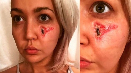 Fotos: así le quedó la cara a una mujer tras la picadura de una araña