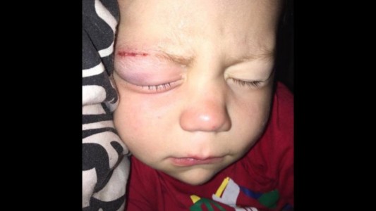 Indignante: llevaron a un nene al hospital y por un error médico le pegaron los ojos con pegamento