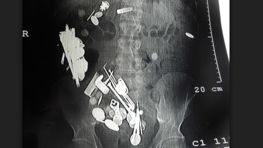 El extraño caso del hombre con depresión que se comió 263 monedas, 150 clavos y una correa para perros