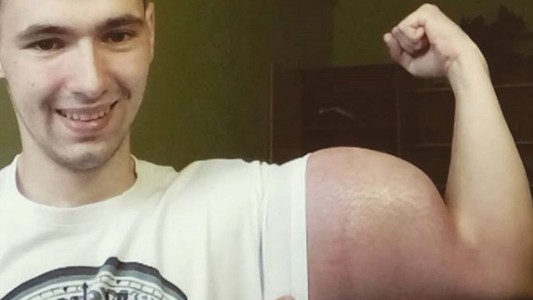 El joven ruso que se inyecta aceite en los brazos y ahora podrían amputarle los brazos