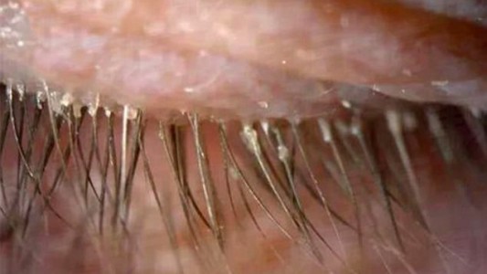 El extraño caso de la mujer china a la que le hallaron 100 parásitos en el ojo