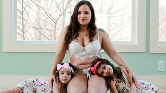 La mujer que ama sus estrías: "Tenía que pasar para tener a mis hijas acá"