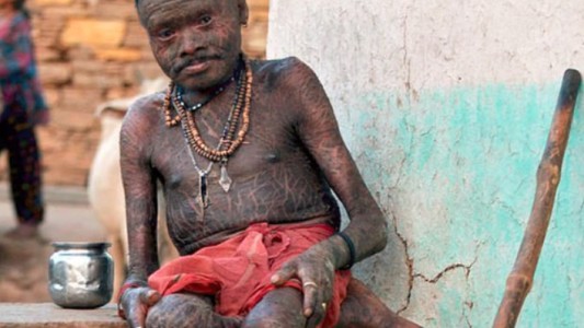 El extraño caso del “hombre serpiente” que cambia la piel cada 10 días