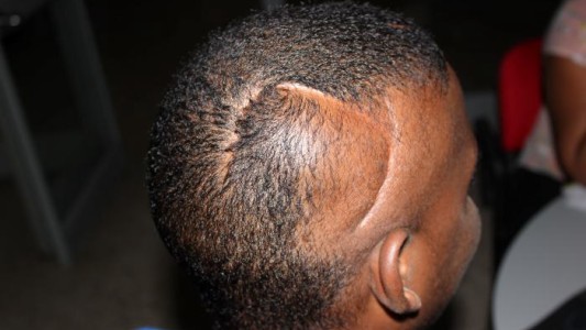 Le realizaron por error una cirugía cerebral a un paciente que no la necesitaba