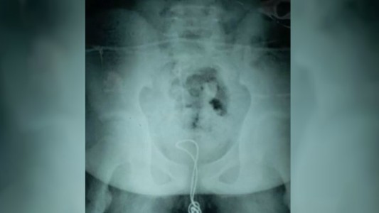 Un joven chino se metió un cable USB por el pene y tuvo que ser operado