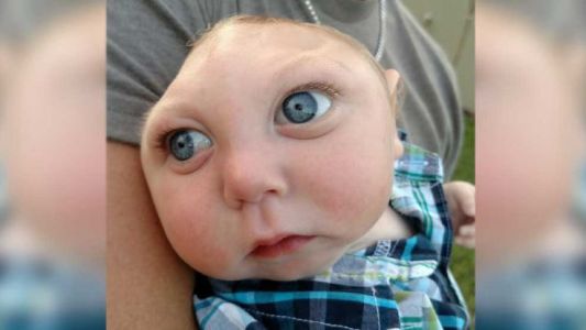 Les aconsejaron abortar, su hijo nació con medio cráneo y ahora festejaron su primer cumpleaños