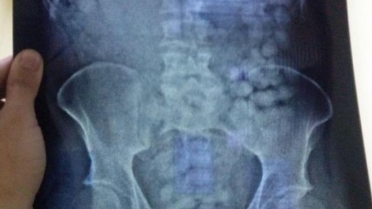 Uruguay: Detuvieron a un ciudadano holandés con más de un kilo de cocaína en el estómago