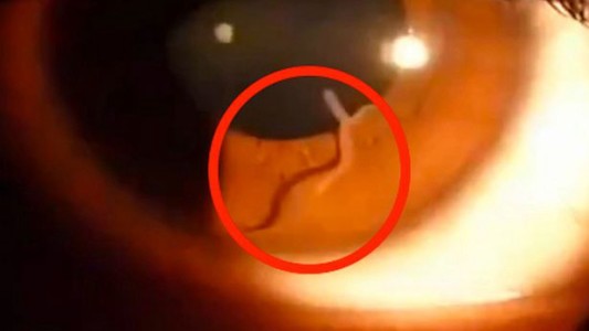 Video: descubren un gusano en el ojo de una mujer