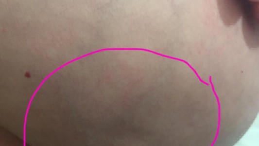 "Así se ve mi cáncer de mama"