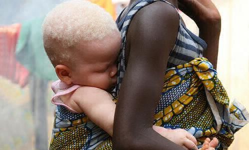 Crece la matanza de albinos en África: mezcla de brujería y superstición
