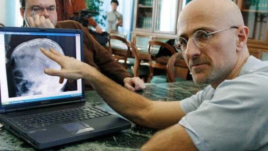 Anuncian dónde se realizará el primer trasplante de cabeza