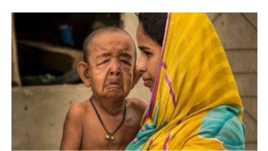 La dramática historia del nene de 4 años que parece de 80