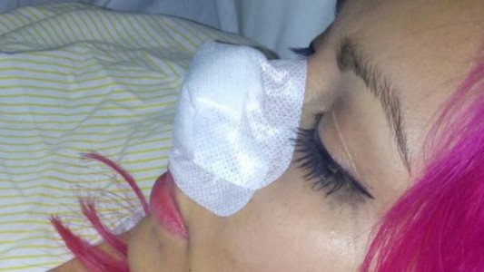 Le arrancó la nariz de un mordisco a la ex de su novio en una discoteca