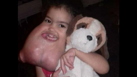 Cirujanos removieron un extraño tumor facial a una nena de tres años