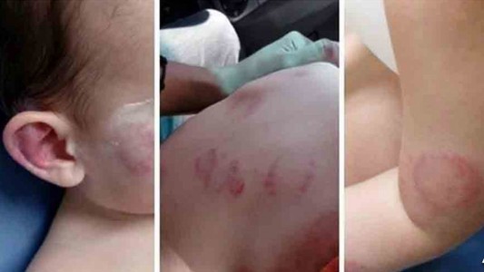 Fue a buscar a su hijo a la guardería y se lo devolvieron con 25 mordiscones