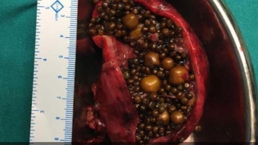 La operaron de urgencia y descubrieron que tenía 838 piedras en la vesícula