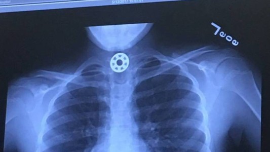 Fue al hospital por dolores de cabeza: tenía una bala alojada en el cráneo