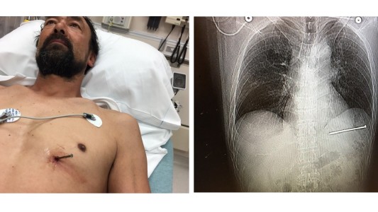 Se disparó un clavo en el pecho mientras trabajaba y manejó hasta el hospital