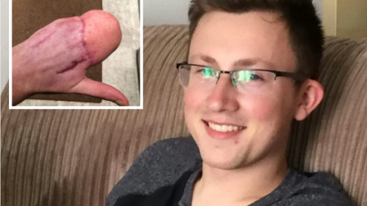 Fotos: así evoluciona el joven que tuvo un trágico accidente y le cosieron la mano al abdomen