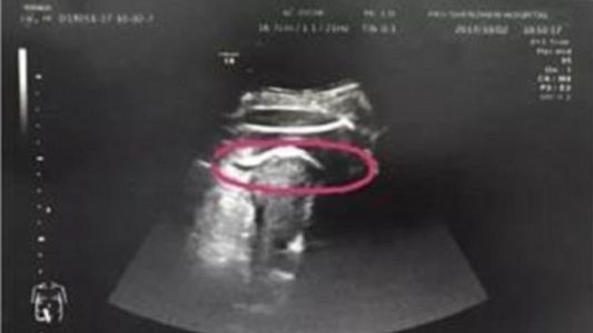 Una mujer estuvo a punto de morir luego de que su bebé le perforó el útero de una patada