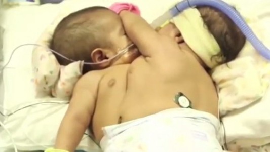 Separaron con éxito a las “Esmeraldas” guatemaltecas, dos siamesas que nacieron unidas por el pecho