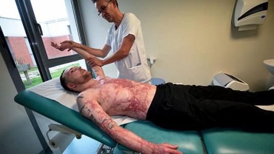 Tiene el 95% del cuerpo quemado y su hermano gemelo le donó el 50% de su piel