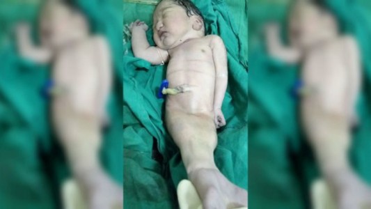 Nació un "bebé sirenita en la India, pero sólo sobrevivió unas horas