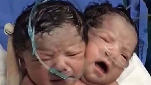 Dolor por la muerte de una de las siamesas "Esmeralda"