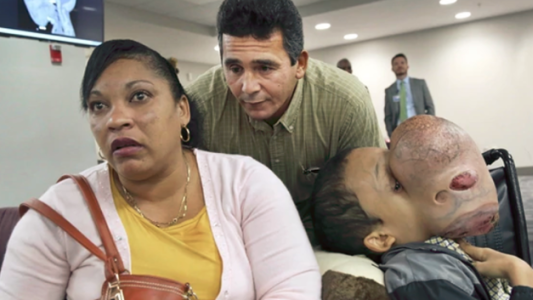 Murió el adolescente cubano al que le extirparon un tumor de 4,5 kilos del rostro