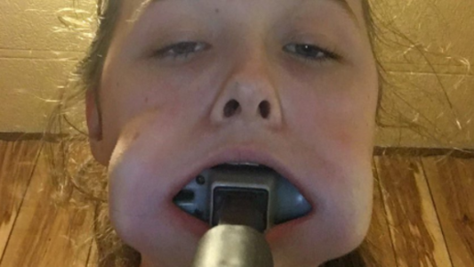 La joven que pide ayuda por las redes sociales para sacarse el martillo de la boca
