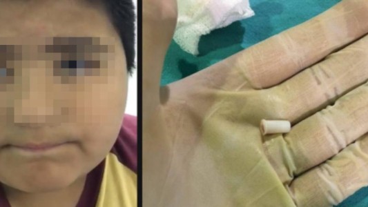 Un nene se tragó un silbato y el video se volvió viral en las redes