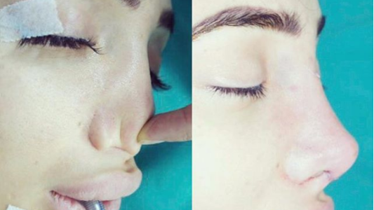Se gastó 112.000 euros en una cirugía estética y terminó sin huesos en la nariz