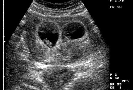 Nacieron mellizos de dos padres y dos madres