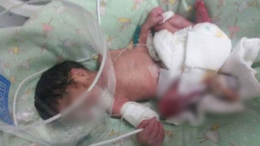 Operaron con éxito a la beba quemada con un caloventor en un hospital pampeano