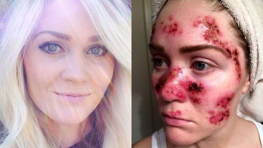 Impactante: una enfermera mostró con una selfie su cáncer de piel