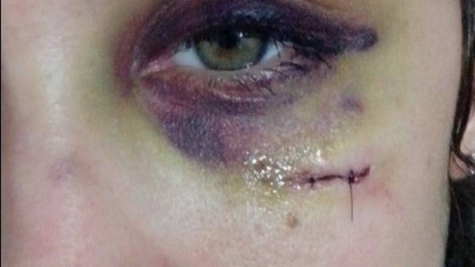 Su ex novio le deformó la cara y ella lo mostró por Facebook