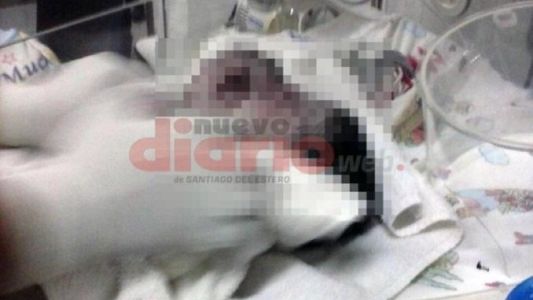 Conmoción en Santiago del Estero por el nacimiento de un bebé con dos cabezas