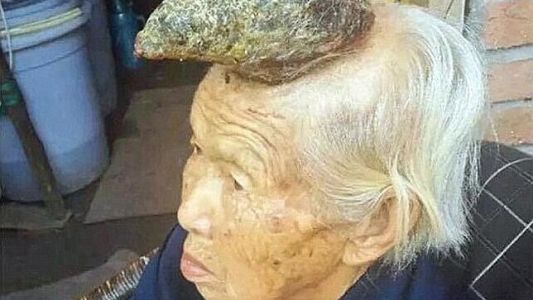 El misterio de la "mujer unicornio" desconcierta a los médicos