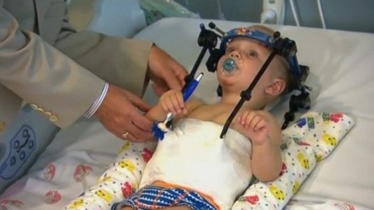 Médicos lograron unir la cabeza de un bebé a su cuerpo, tras un accidente