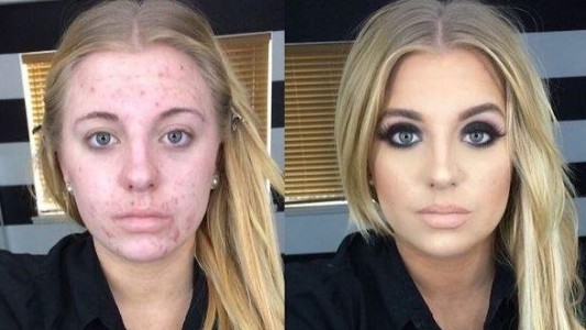 La emotiva respuesta de una chica que fue ridiculizada en Internet por su acné