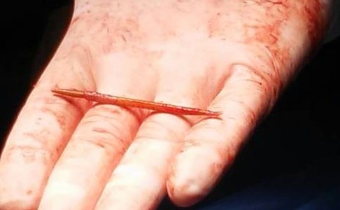 Operación inédita: le sacaron del corazón un escarbadientes que se tragó en una picada