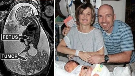 Inusual caso: nació dos veces para salvarse de un tumor