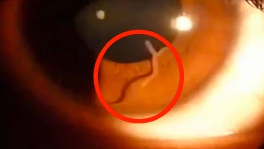 Video: descubren un gusano en el ojo de una mujer