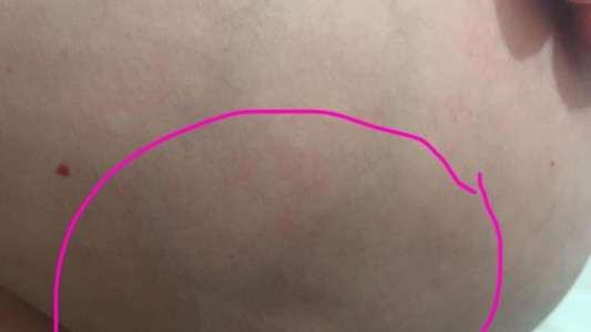 "Así se ve mi cáncer de mama"