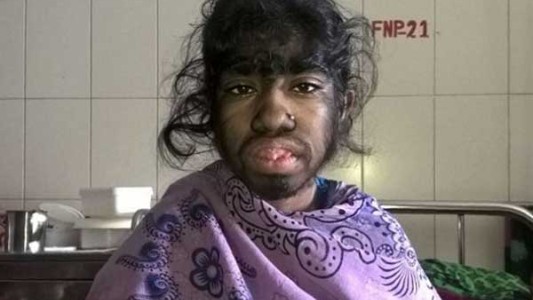 El drama de la nena que padece "síndrome de lobo" en Bangladesh