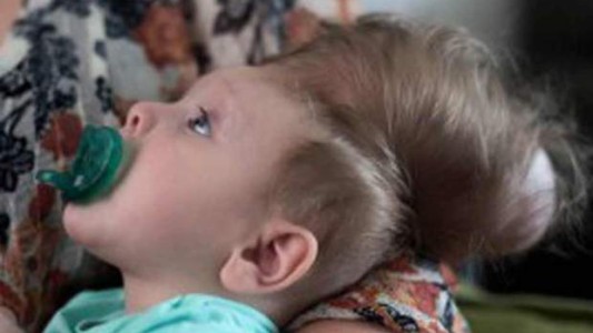 Video: La conmovedora historia del bebé que logró sobrevivir con el cerebro fuera del cráneo