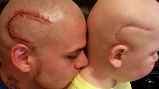 Amor de padre: se tatuó la misma cicatriz que su hijo operado de cáncer